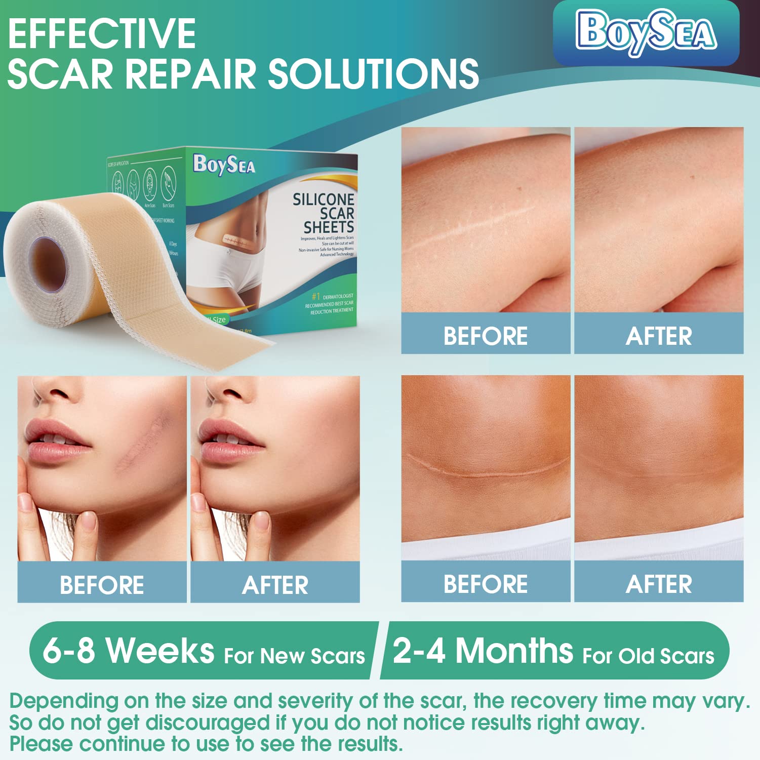 Boysea silicone scar sheets waterproof and flexible for daily wear