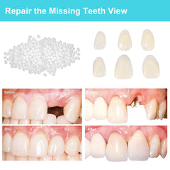 Beads softened in hot water for forming a replacement tooth