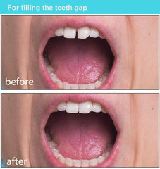 Moldable beads shaped to fit a tooth, ready for setting