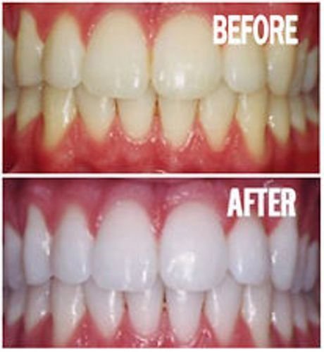 Packaging for Bright White Smiles Teeth Whitening Gel Refill Kit