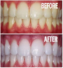Packaging for Bright White Smiles Teeth Whitening Gel Refill Kit