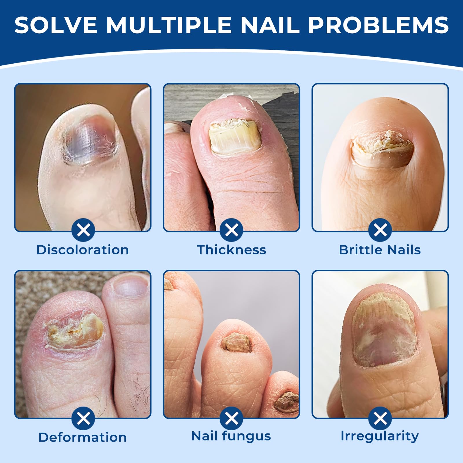 CFKDY patch on toe close-up – easy application for damaged nails.