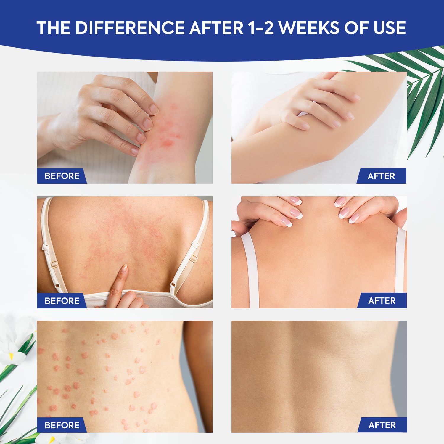 CHARMPOO antifungal cream ringworm-affected-area close-up highlights targeted skin comfort.