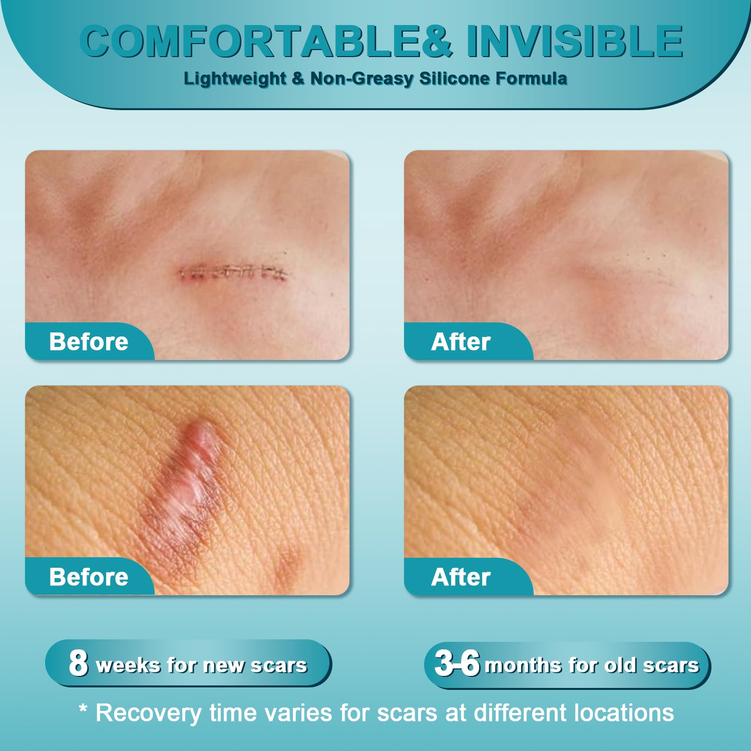 ClearPiny Scar Cream on skin creating breathable, protective barrier.