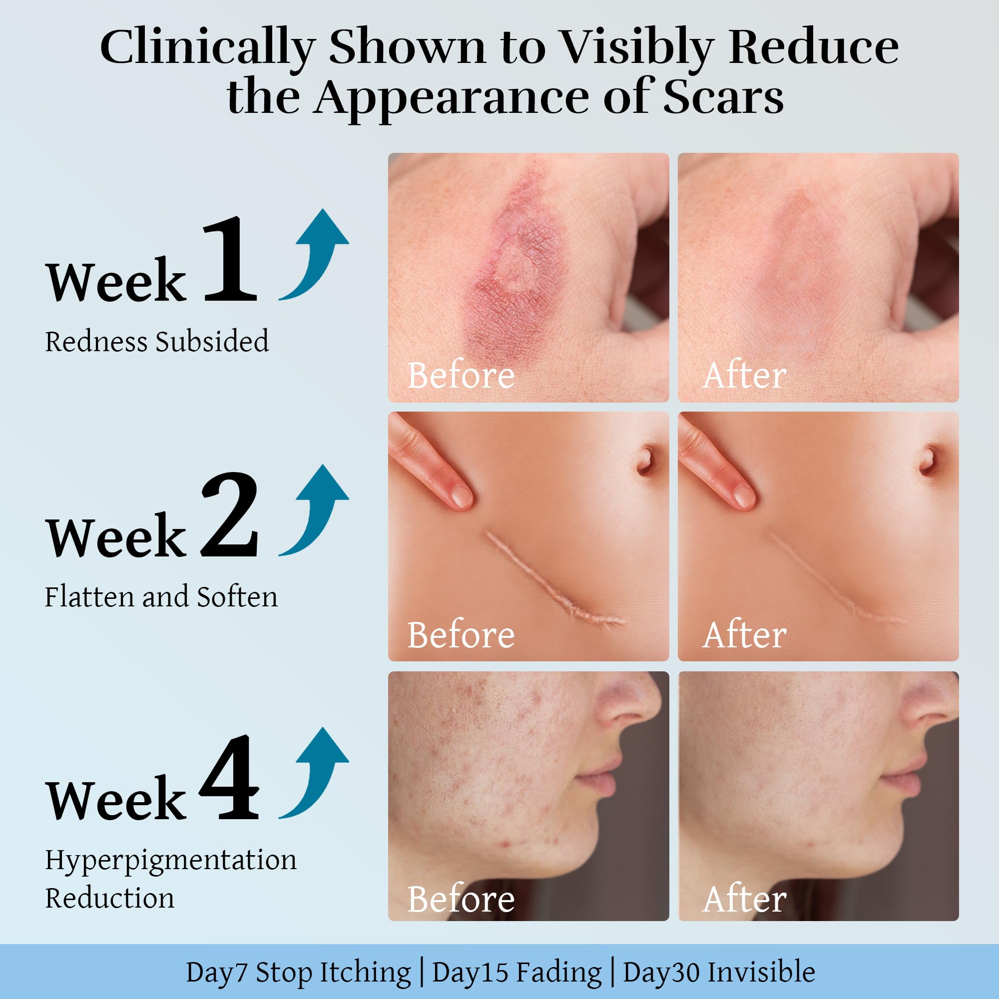 CLNABFR scar cream being applied to skin to illustrate daily routine.