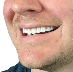 Comfort Fit Flex veneer close-up showing ultra-thin design