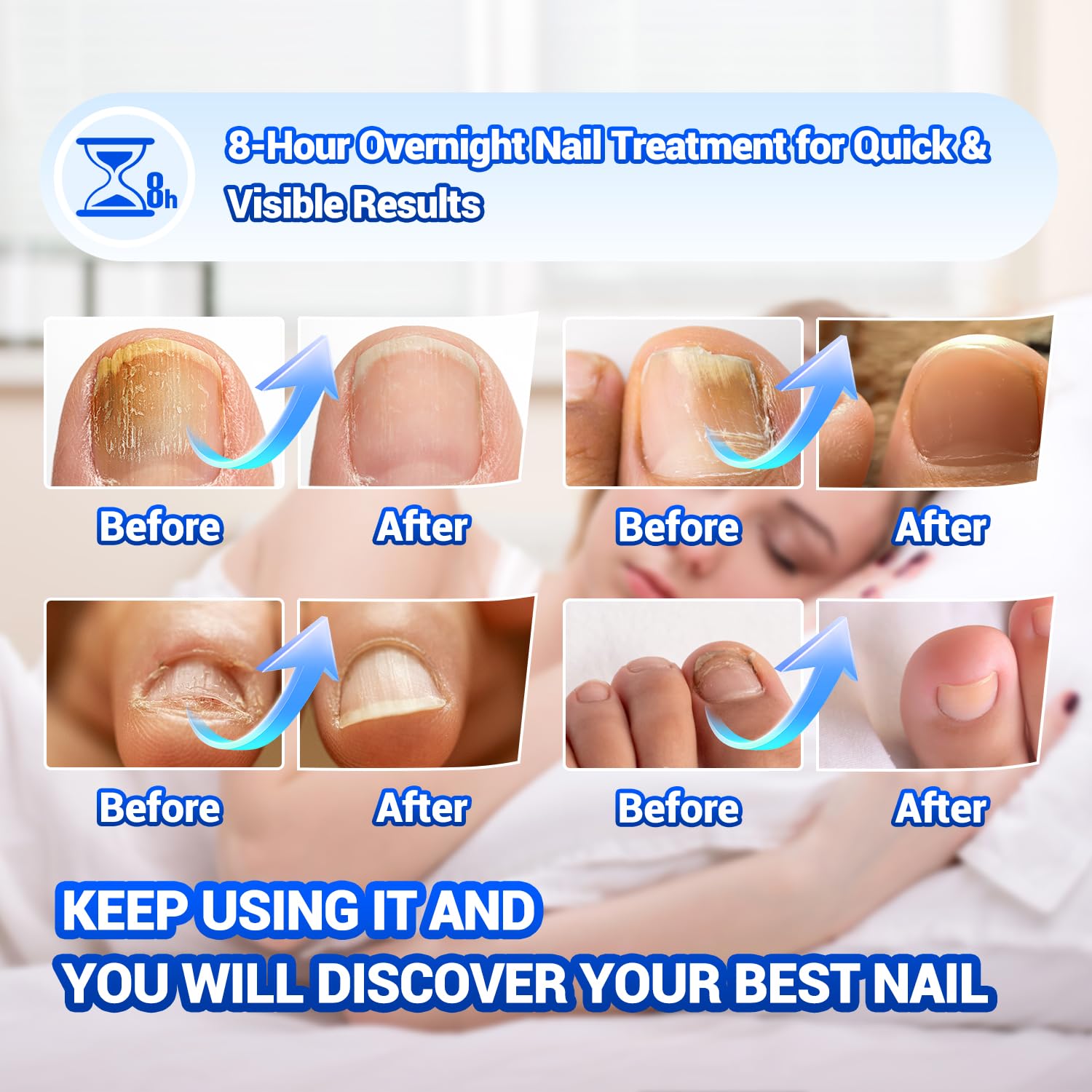 Comfort Toenail Discoloration Before displays nails prior to treatment.