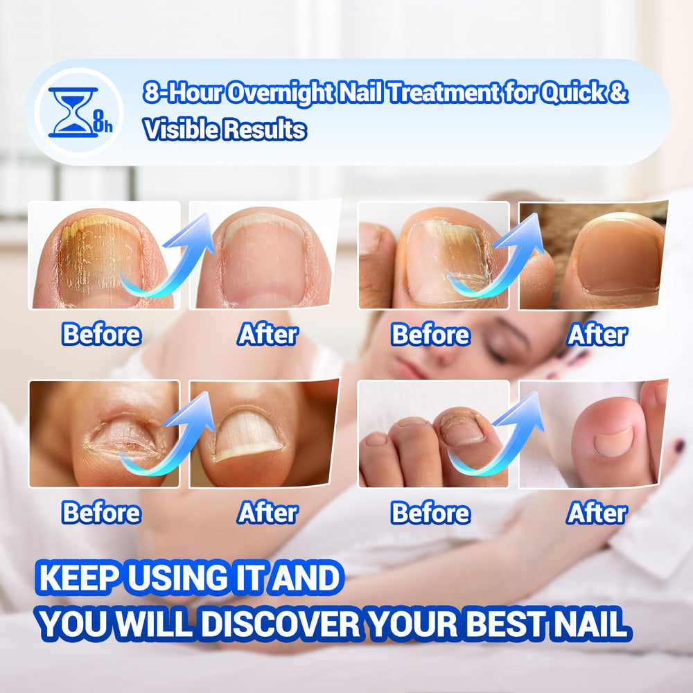 Comfort Toenail Discoloration Before displays nails prior to treatment.