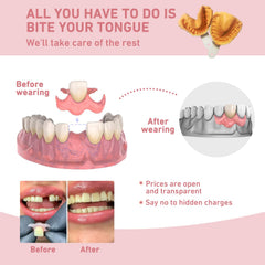 4-tooth partial dentures configuration