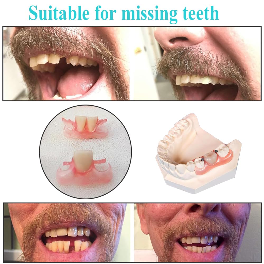 Moldable resin materials and tools in a DIY denture kit