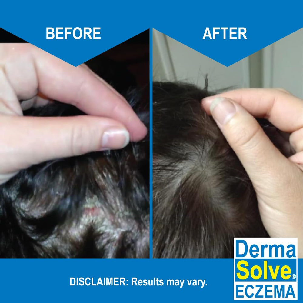 Dermasolve Eczema Relief Shampoo with colloidal oatmeal image shows moisture protection for dry scalps.
