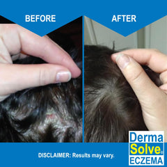 Dermasolve Eczema Relief Shampoo with colloidal oatmeal image shows moisture protection for dry scalps.