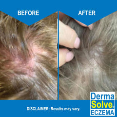 Dermasolve Eczema Relief Shampoo texture close-up emphasizes the low-foam, creamy cleanse.