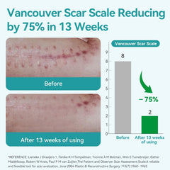 Dimora silicone scar sheets on skin demonstrate comfortable wear for daily activities.