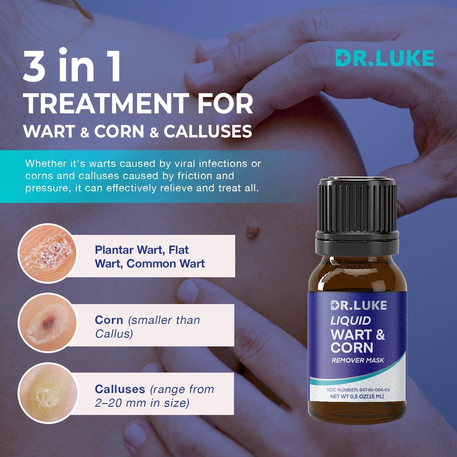 Dr. Luke plantar wart remover foot application on sole