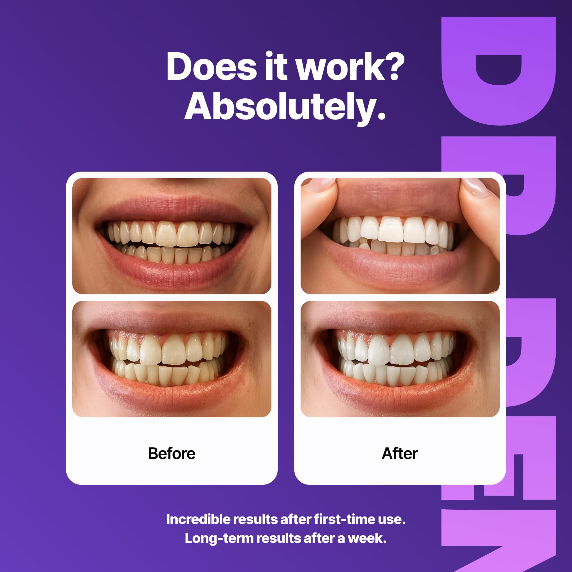 Smiling person showing whiter teeth after using DRDENT