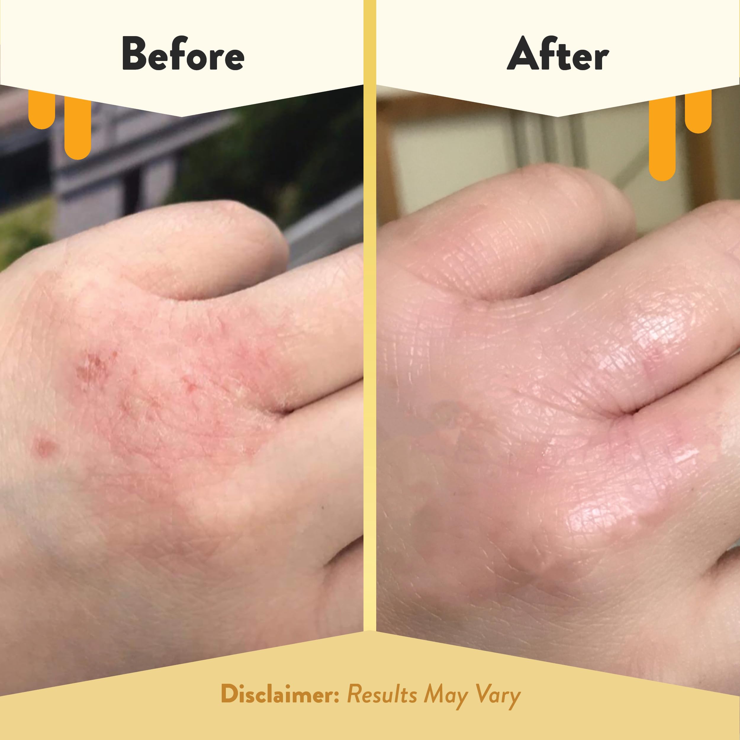 ECZEMA HONEY packaging shows dermatologist tested label for safety and trust.