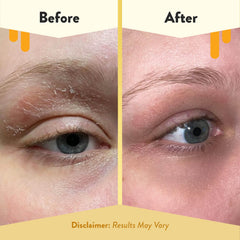 ECZEMA HONEY ingredients honey and colloidal oatmeal emphasize soothing itch relief for dry under-eye skin.