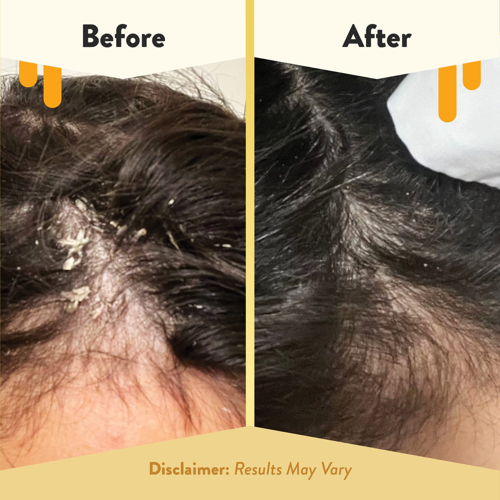 ECZEMA HONEY ingredients-tea-tree-jojoba highlight soothing, nourishing care.