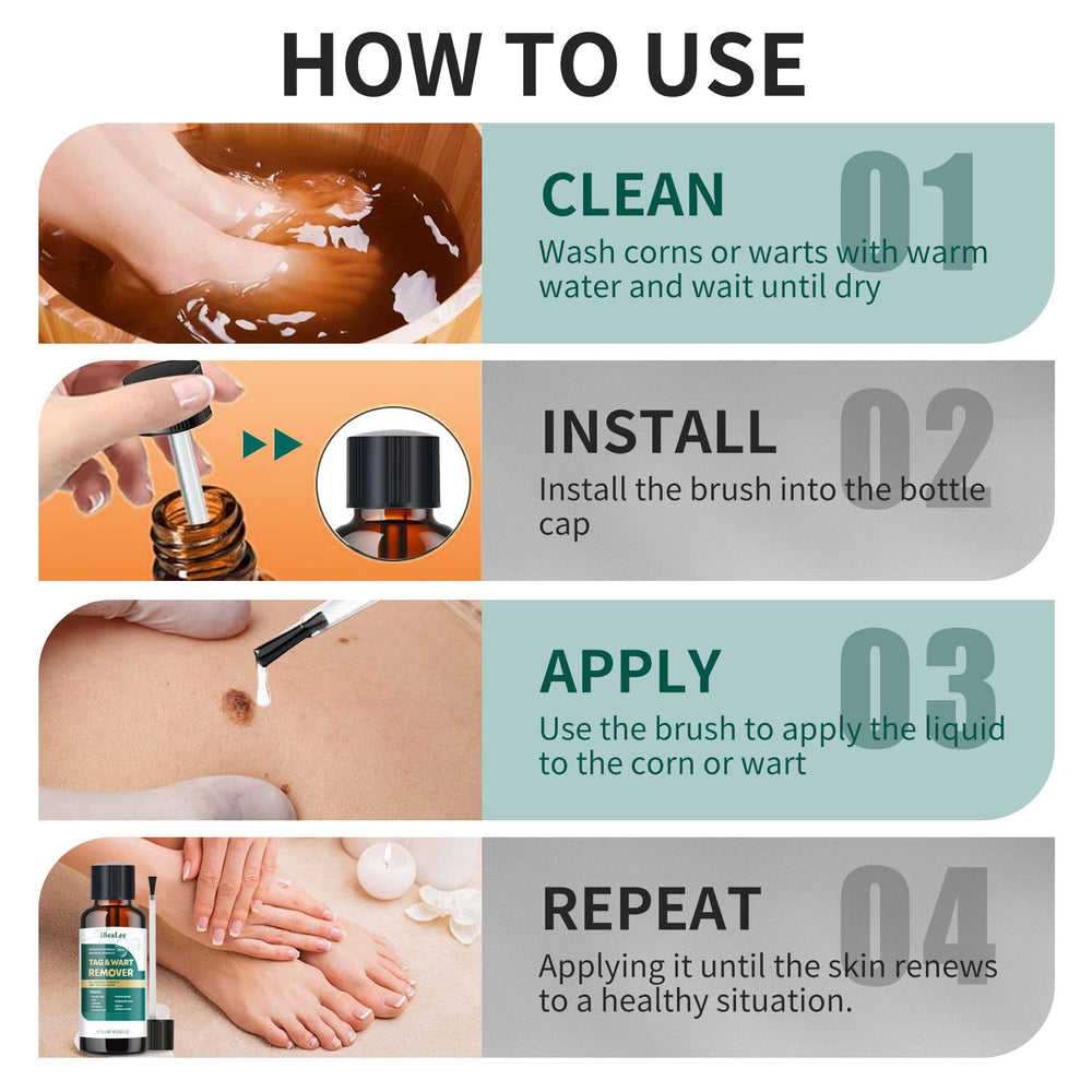 ELEFOCUS wart remover liquid applied to plantar wart area for treatment