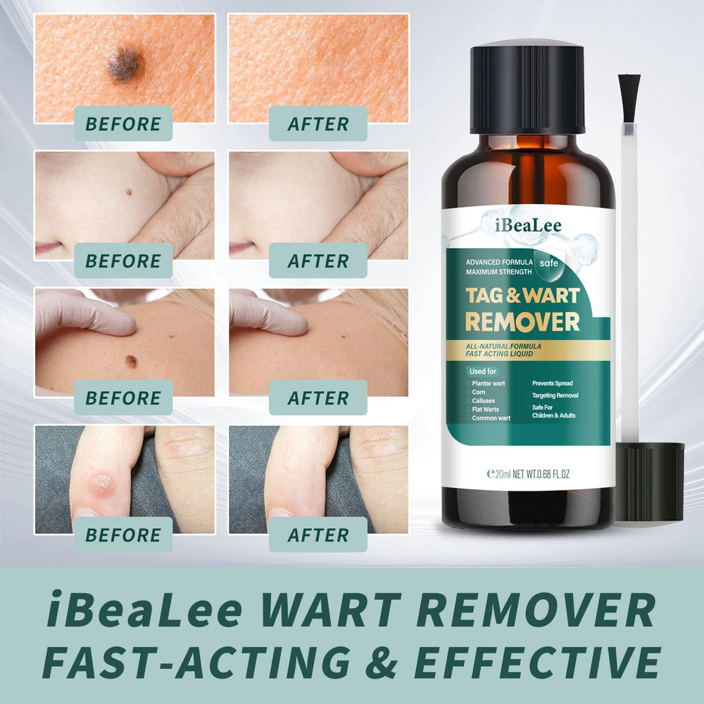 ELEFOCUS wart remover liquid packaging for easy at-home use