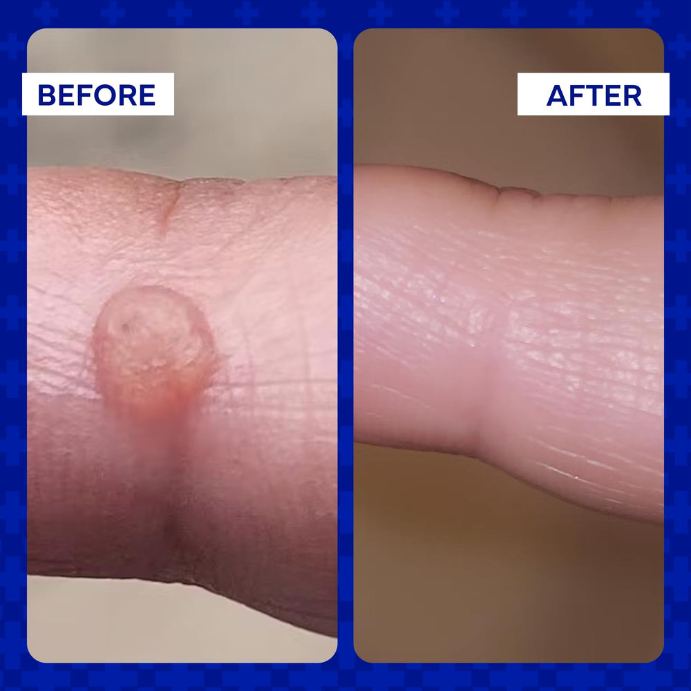 emuaid ointment in use during daily skincare routine for flare-ups