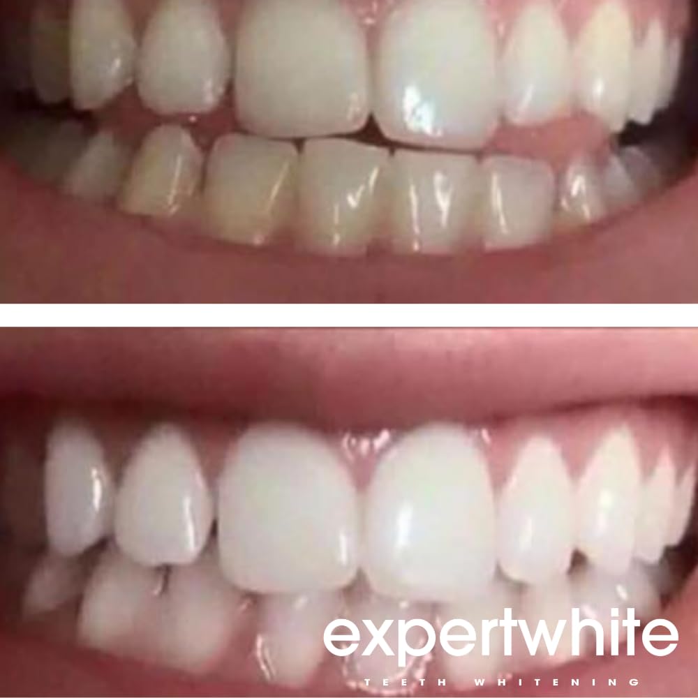 Tray-ready whitening gel bottles for at-home dental whitening.