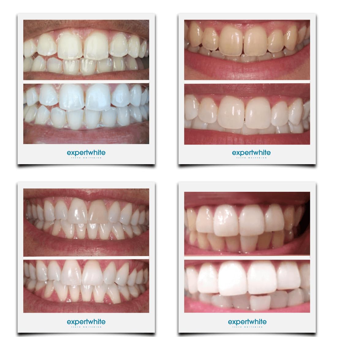 Whitening gel refills compatible with Invisalign trays and aligners.