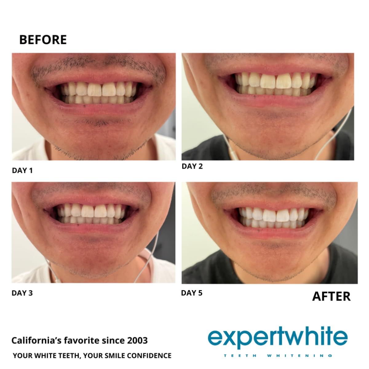 Before and after teeth whitening results