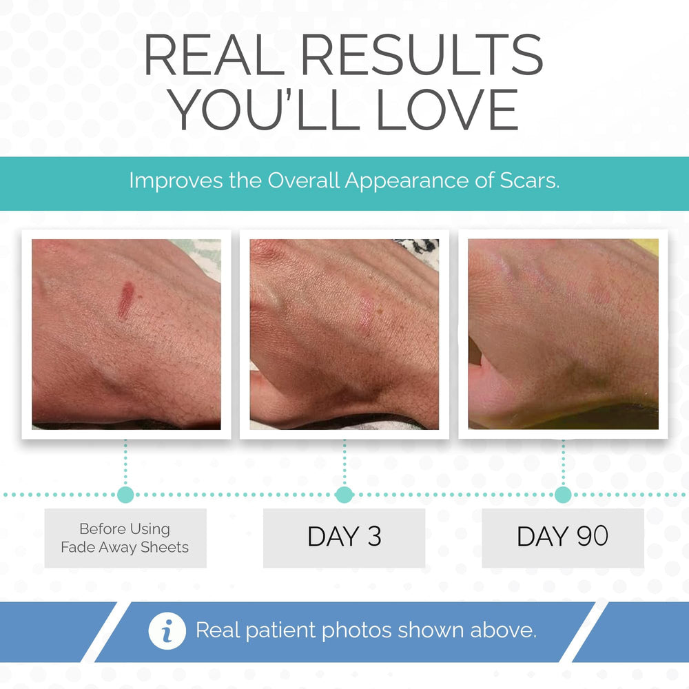 Fade Away silicone scar sheets cut-to-size close-up enables precise scar coverage