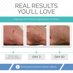 Fade Away silicone scar sheets cut-to-size close-up enables precise scar coverage