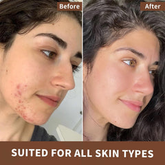 Tea tree oil applied for skin and nails