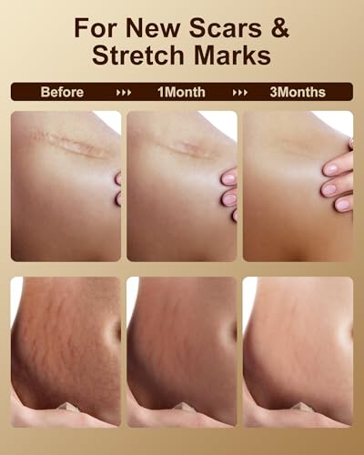 Flowhyet Vitamin E Oil for stretch marks supports smoother-looking skin.