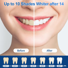 At-home professional-grade whitening gel technology