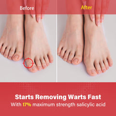 Goodnites wart remover cap closeup for clean, mess-free application.