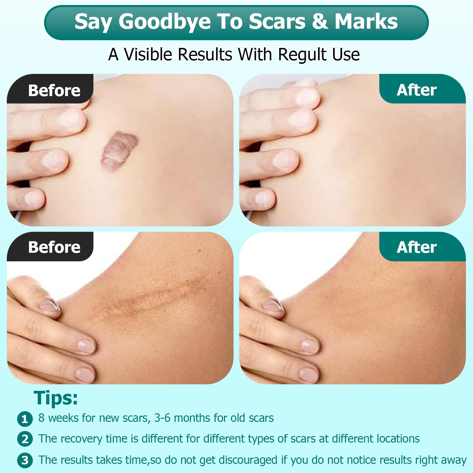 Gowgaw silicone scar gel on an old scar for improved texture