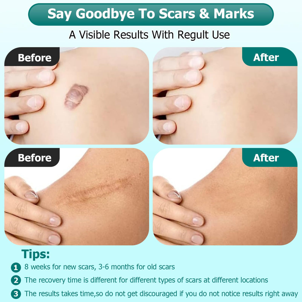 Gowgaw silicone scar gel on an old scar for improved texture