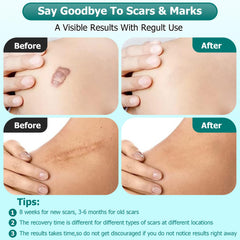 Gowgaw silicone scar gel on an old scar for improved texture