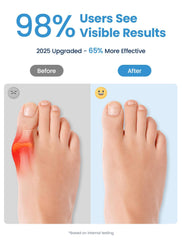 Habioer toe separators demonstrate natural big-toe alignment and reduced toe friction