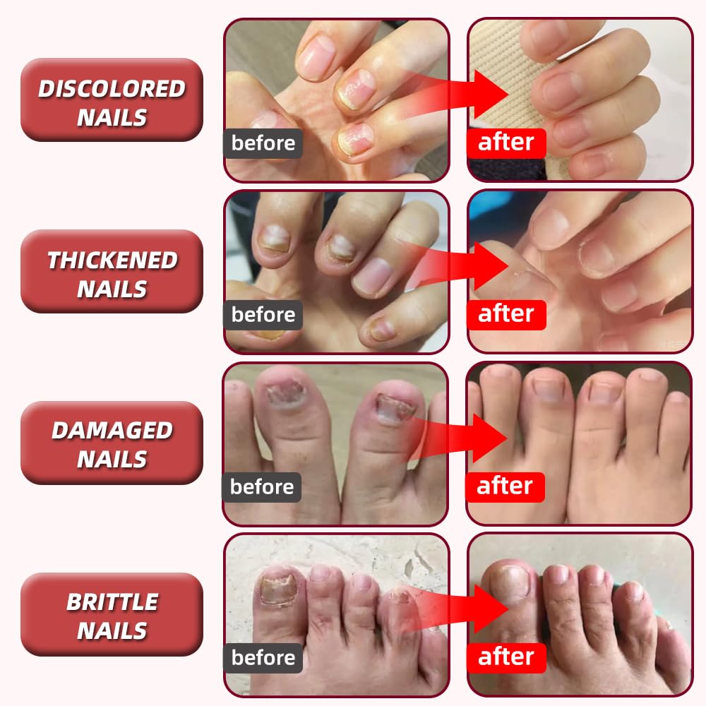 HAIDWEN close-up of nail treatment on brittle nails.