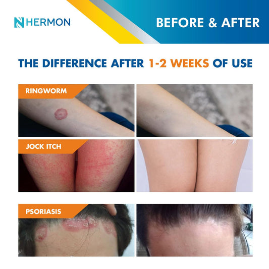 Hermon ringworm cream tube ready for easy on-skin application.