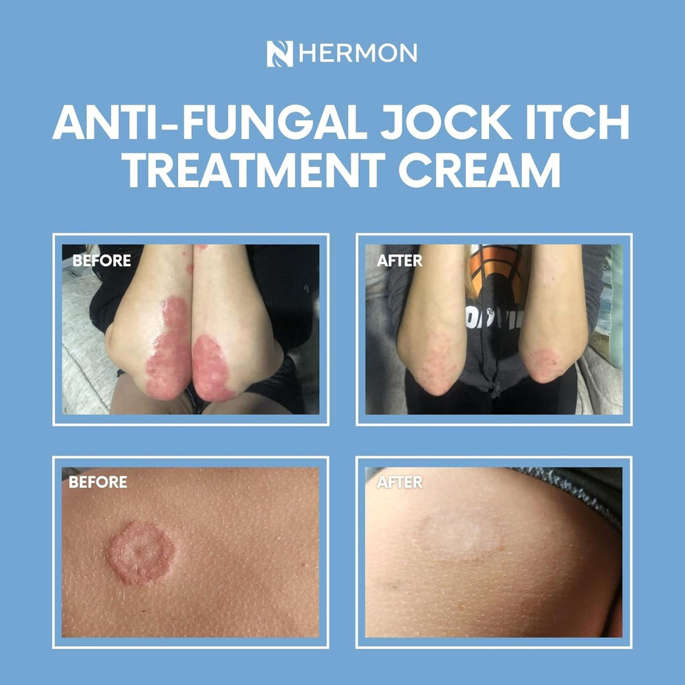 Hermon Jock Itch Cream lid-open shot for easy application