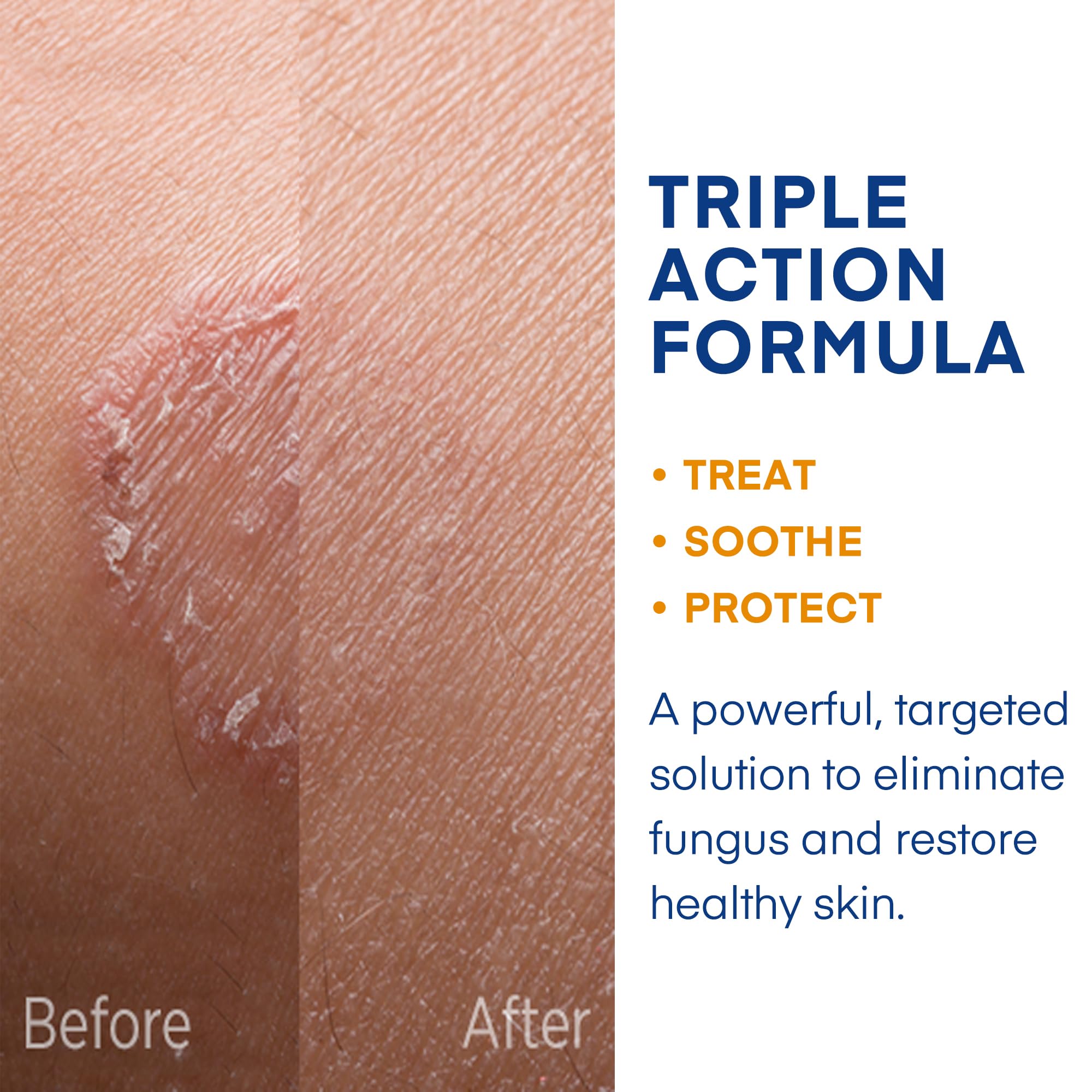 Hermon cream on forearm demonstrating localized application for common infections.