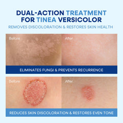 Hermon Tinea Kit Complete showcases a multi-step approach for skin health.