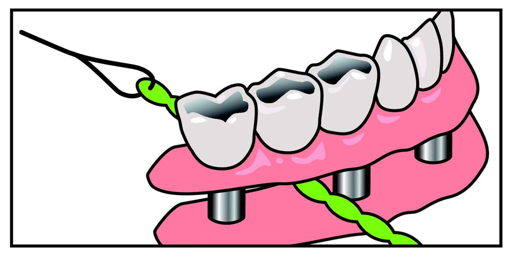 IDontix Brace X-Floss Green product image 3 – floss used around implants and bridges