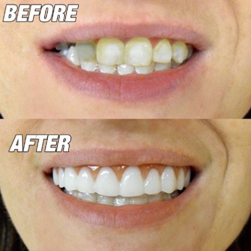 One size fits most - product illustration of aligner