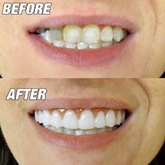 One size fits most - product illustration of aligner