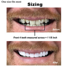 All veneers displayed together for sizing and fit reference