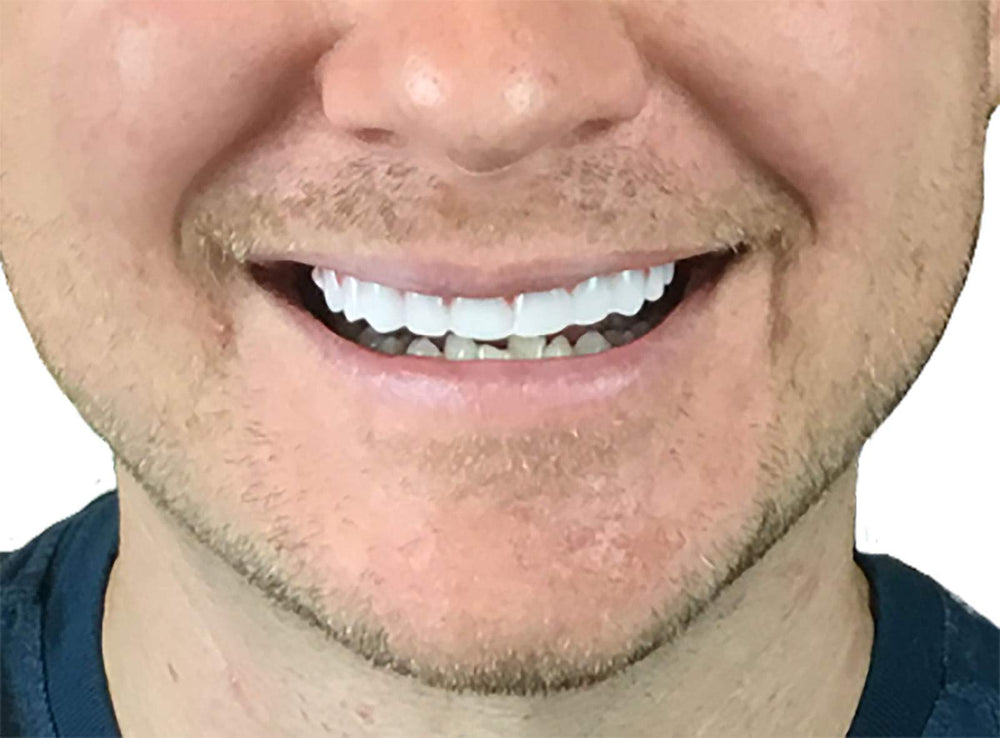 Upper cosmetic veneer resting on a teeth model