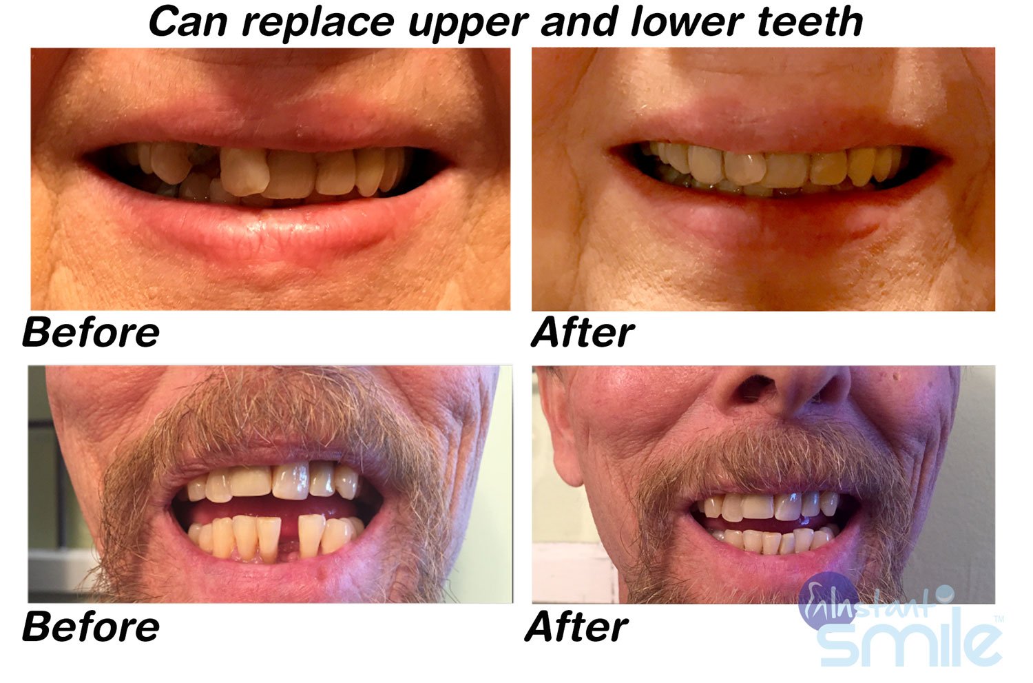 Patented design ensuring a realistic look and feel for temporary tooth repair
